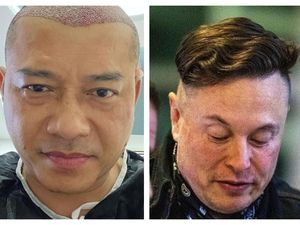 Anang Hermansyah Botak Transplantasi Rambut, Elon Musk Juga Pernah Anang Hermansyah Botak Transplantasi Rambut, Elon Musk Juga Pernah
