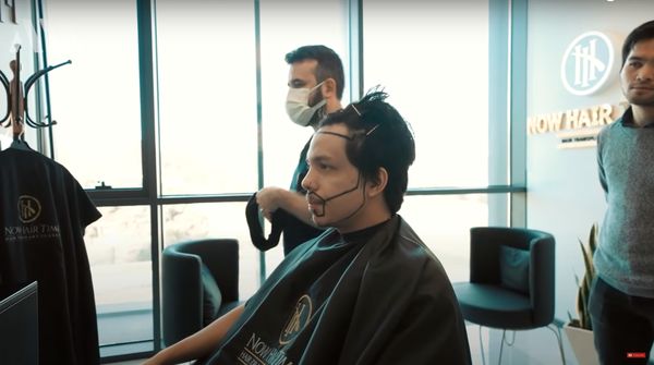 Foto 10 Artis Ini Transplantasi Rambut, Atta Halilintar Tanam Rambut di Turki