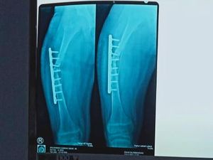 Siswa SMP di Banyuwangi Di-bully Hingga Tulang Pahanya Harus Dipotong 4 Cm