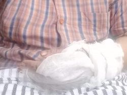 Penyiram Air Keras Ibu-Anak di Palembang Ditangkap, Pelakunya Sang Suami