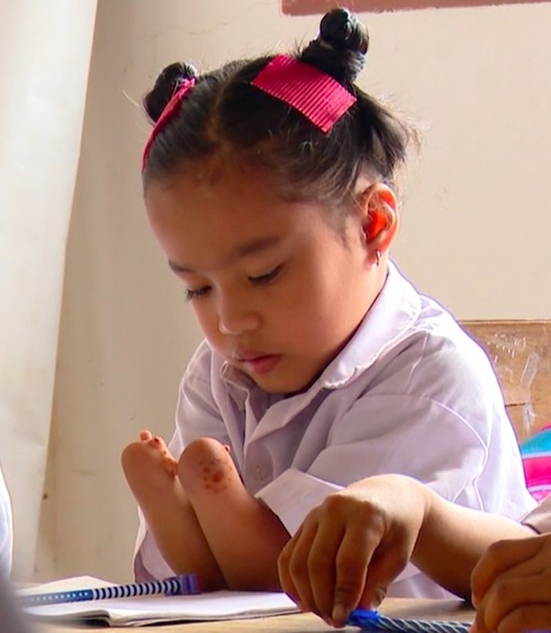 Sosok Fitriani, Gadis Tanpa Telapak Tangan-Kaki yang Tak Pernah Menyerah