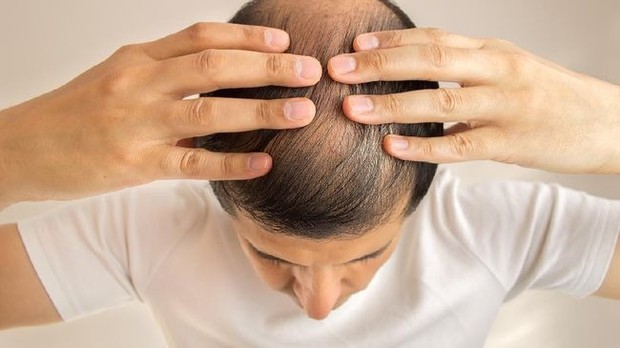 Ramai dicoba para artis, ternyata ini manfaat transplantasi rambut/Foto: cnnindonesia.com