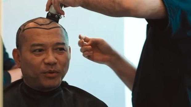 Viral! Anang Hermansyah dan menantu lakukan transplantasi rambut. Begini manfaat, efek samping serta biayanya/Foto: detik.com
