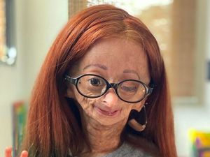 Youtuber 15 Tahun Meninggal Idap Penyakit Benjamin Button, Kondisi Apa Itu? Youtuber 15 Tahun Meninggal Idap Penyakit Benjamin Button, Kondisi Apa Itu?