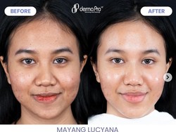 Transformasi Mayang Setelah Perawatan Wajah Rp 80 Juta, Jadi Begini