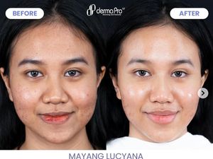 Transformasi Mayang Setelah Perawatan Wajah Rp 80 Juta, Jadi Begini Transformasi Mayang Setelah Perawatan Wajah Rp 80 Juta, Jadi Begini