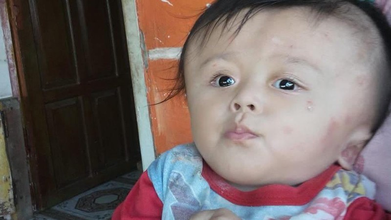 Serba-serbi Hidrosefalus yang Diidap Vivi, Kini Butuh Bantuanmu