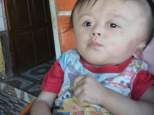 Tolong! Balita Penderita Hidrosefalus Ini Butuh Operasi Rekonstruksi Kepala