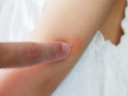 Terlalu Lama Terkena Matahari Bisa Biduran, Kenapa ya Dok?