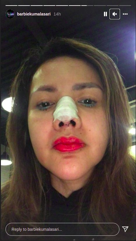 Barbie Kumalasari jalani operasi hidung.