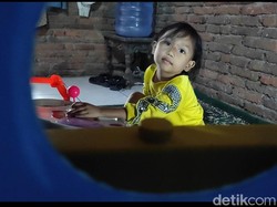 Kisah Pilu Jia, Bocah Sulsel Berjuang Lawan Penyakit Langka Sejak Lahir