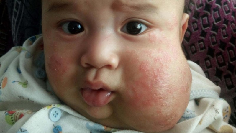 Derita Balita Rakha, Pipi Membesar karena Penyumbatan Pembuluh Getah Bening