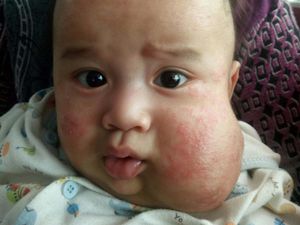 Derita Balita Rakha, Pipi Membesar karena Penyumbatan Pembuluh Getah Bening