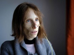 5 Kondisi Langka Buat Orang Tak Bisa Berhenti Makan sampai Makan Lewat Selang