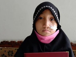 Mengenal Sindrom Wolf Hirschhorn, Diidap Haura Bocah 9 Tahun