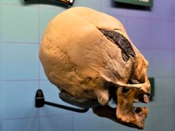 Tengkorak Kerucut dengan Implan Logam Bikin Bingung Ilmuwan