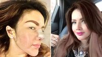 Penampakan 8 Artis Operasi Hidung, Barbie Kumalasari Habiskan Rp 50 Juta