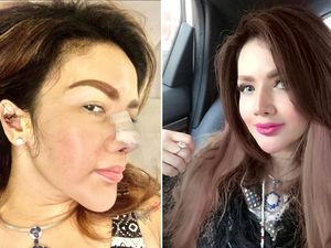 Penampakan 8 Artis Operasi Hidung, Barbie Kumalasari Habiskan Rp 50 Juta