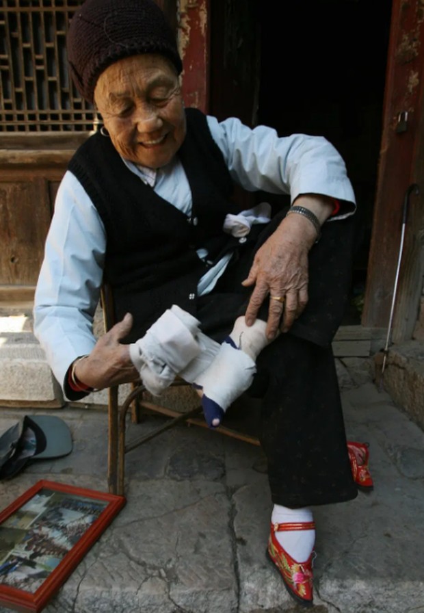 Foot binding/Foto : thesun.co.uk Tradisi meremukkan tulang telapak kaki untuk mendapat ukuran kaki yang kecil menjadi syarat perempuan Tiongkok untuk menikah di jaman dulu