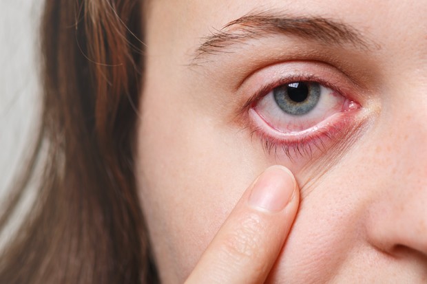 Conjunctivitis Eye Pain