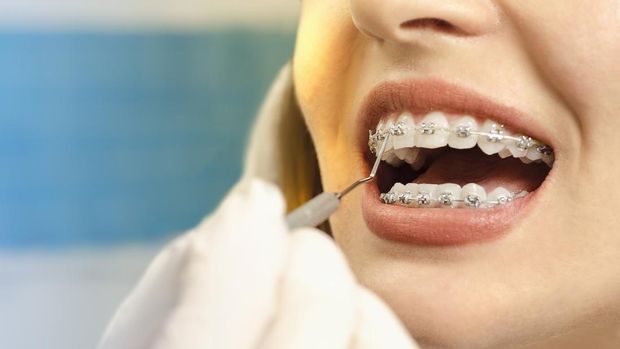 Closeup dental braces checkup , perfect white teeth with dental braces woman in half smile