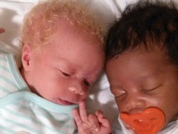 Anak Kembar Tapi Tak Mirip, Beda Warna Kulit, Dikira Tertukar Ternyata...