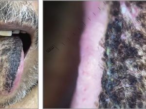 Lidah Pria Ini Menghitam dan Ditumbuhi Bulu, Apa Penyebabnya? Lidah Pria Ini Menghitam dan Ditumbuhi Bulu, Apa Penyebabnya?