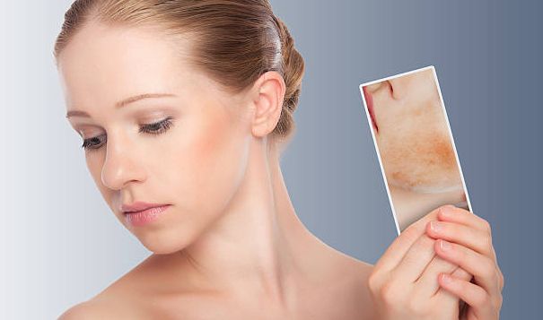 Kulit sensitif akan lebih cepat memerah dan iritasi sehingga harus dirawat dengan skincare yang bersifat menangkan / foto: freeimages.com