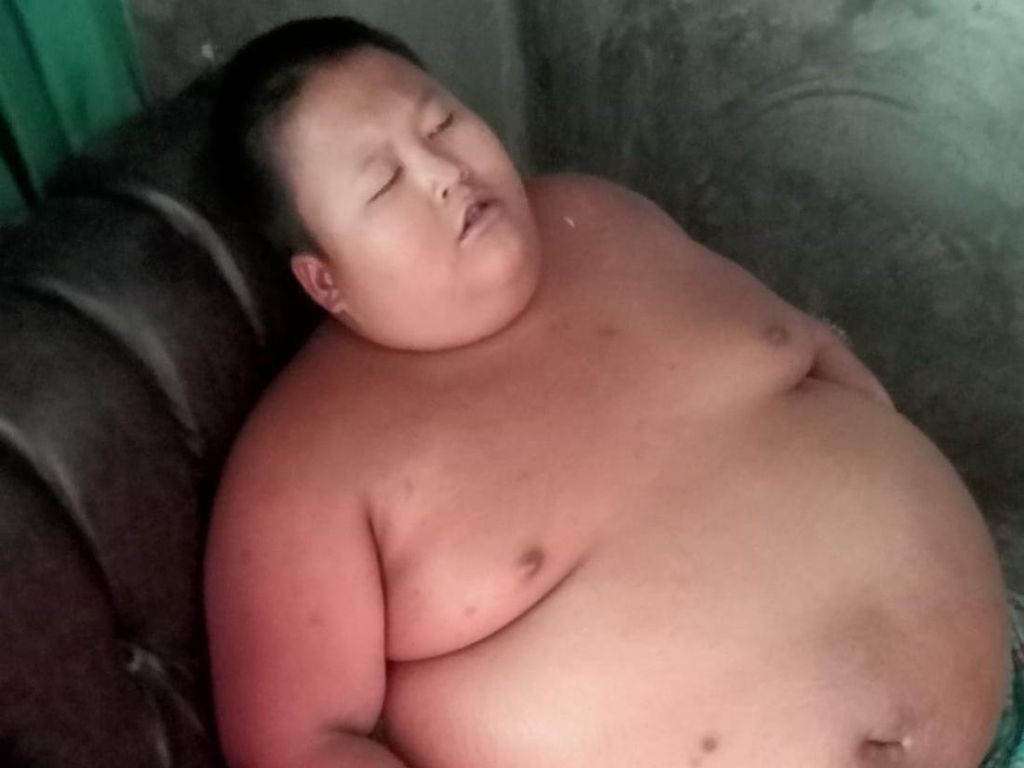 Viral Bocah 11 Tahun di Bekasi Alami Obesitas, Berat Badan 126 Kg