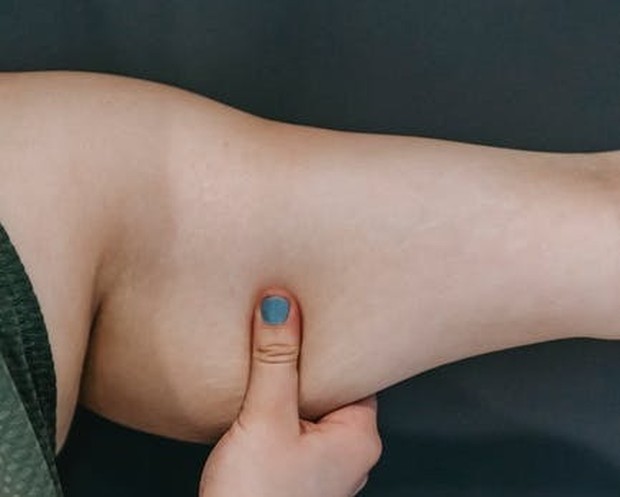 Ciri tubuh alami retensi air, akan timbul lekukan di permukaan kulit/Foto: pexels.com/Andres Ayrton