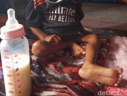 Pilu Muhammad Sultan, Bocah Yatim Penderita Gizi Buruk di Dompu NTB