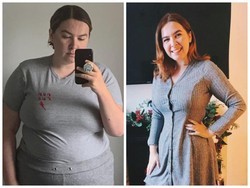 Kondisi Langka! Wanita Ini Harus Dioperasi karena Tak Bisa Berhenti Makan