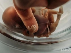 Kepala Bayi Putus Saat Persalinan di Puskesmas Indragiri Hilir