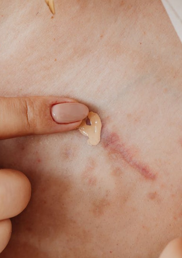 Luka Lebih Lambat untuk Sembuh