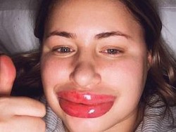 Wanita Ini Alergi dengan Filler, Bibirnya Berakhir Seperti Karakter di Monster Inc