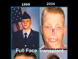 Kisah Pria yang Kesetrum Hingga Wajahnya Meleleh, Butuh Transplantasi Wajah