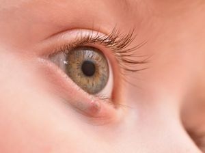 Ketahui Penyebab Kelopak Mata Bengkak, Gejala, dan Cara Mengobatinya