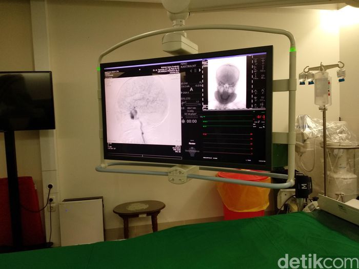 Terapi cuci otak Digital Substraction Angiography (DSA) kembali jadi kontroversi. Meski sudah diteliti sebagai disertasi S3, terapi ini belum pernah uji klinis. (Widiya Wiyanti/detikHealth)