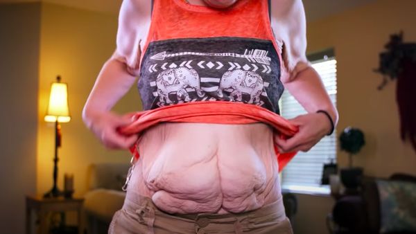 Foto: Transformasi Wanita Berhasil Turun BB 153 Kg, Tapi Bikin Miris