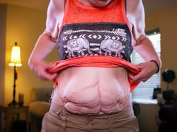 Berhasil Turun BB 153 Kg, Wanita Ini Benci Tubuhnya karena Kulit Bergelambir