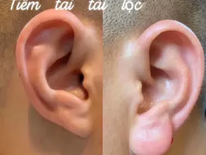 Tren Kecantikan di Vietnam, Suntik Filler di Telinga Agar Mirip Buddha