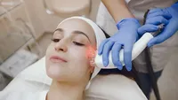 Tips Glowing Kilat, 3 Perawatan Laser Ini Bisa Hilangkan Bekas Jerawat ...