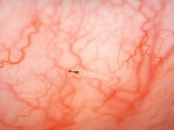 Bikin Merinding! Dokter Temukan Puluhan Belatung Bersarang di Mata Pria Ini