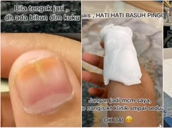 Gara-gara Bihun Kering Nyangkut di Kuku, Wanita Ini Harus ke RS
