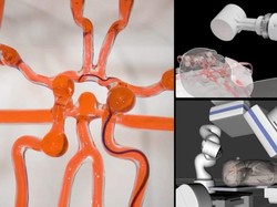 Keren! Robot Ini Bisa Operasi Stroke Jarak Jauh