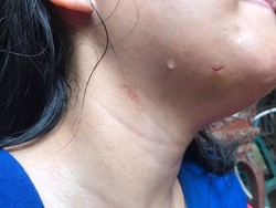 Tak Digorok, Anak Terkena Sabetan Pisau Ibu di Jaktim Hanya Luka Kecil