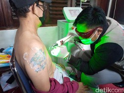 Tak Bisa Instan, Begini Cara Kerja Hapus Tato Pakai Laser