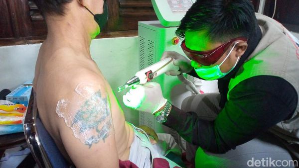 Perjuangan Hapus Tato, Ditembak Laser hingga Disetrika-Ditaburi Bubuk PK