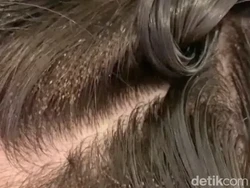 7 Cara Menghilangkan Kutu Rambut dan Kenali Penyebabnya Agar Terhindar