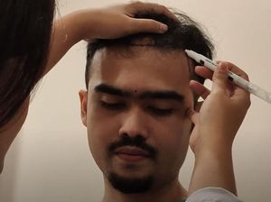 Ini Saran dan Pantangan untuk Pasien Implan Rambut Ini Saran dan Pantangan untuk Pasien Implan Rambut
